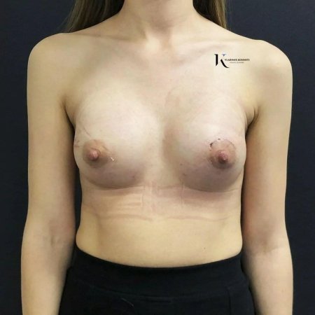 Увеличение груди