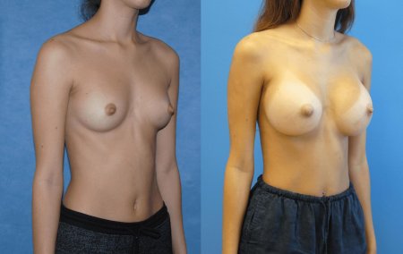 Breast augmentation
