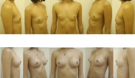 Голая грудь первого размера