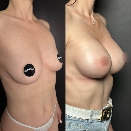 Сиськи импланты