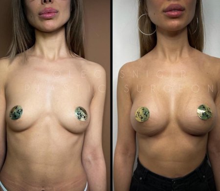 Большие сиськи импланты