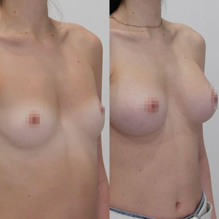 Увеличение груди до и после голые