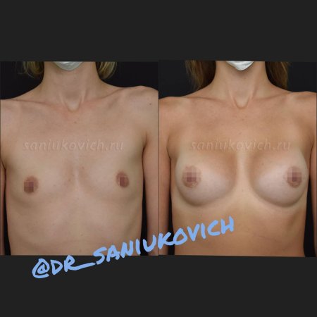 Увеличение груди