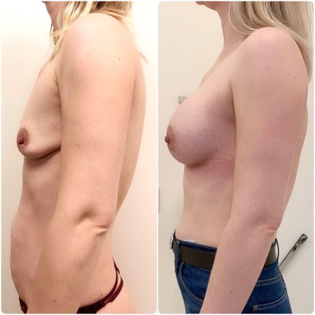 Увеличение груди имплантами