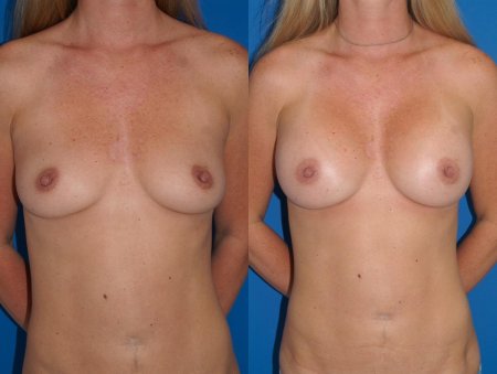 Грудь увеличение