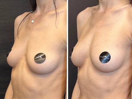 Увеличение груди