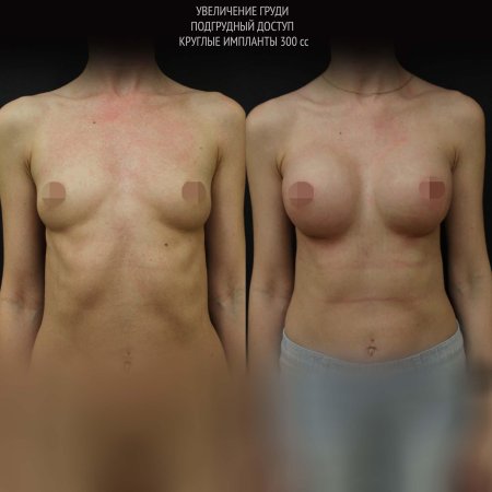 Грудь с круглыми имплантами