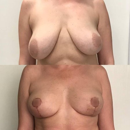 Коррекция груди до и после