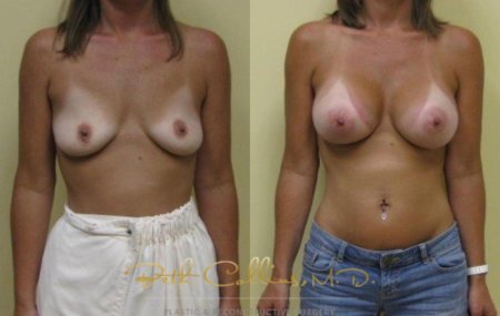 Nikki benz before and after breast enhancement