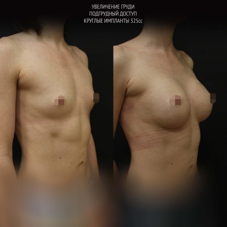 Увеличение молочных желез