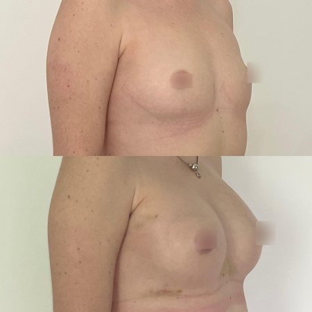 Эндоскопическое увеличение груди