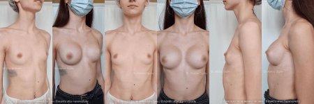 Пластика груди