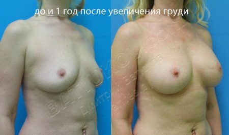До и после увеличения груди