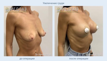 Увеличение груди