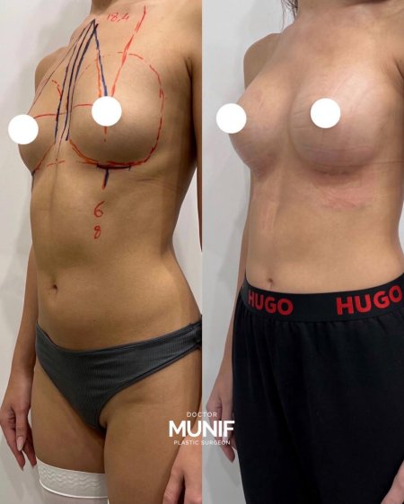 Увеличение груди анатомическими имплантами