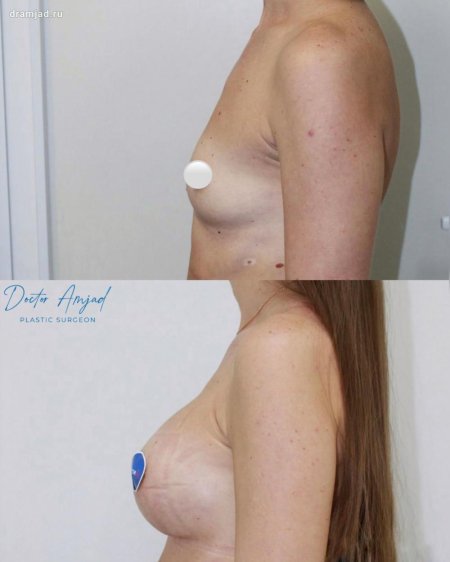 Увеличение груди анатомическими имплантами