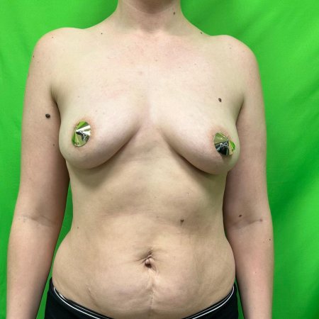 Увеличение груди