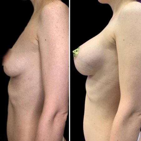 Для увеличения груди