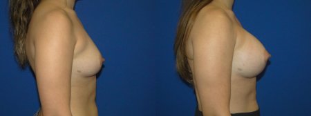 Для увеличения груди