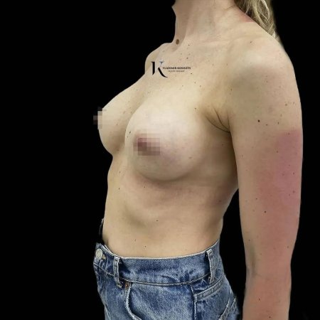 Маммопластика до и после