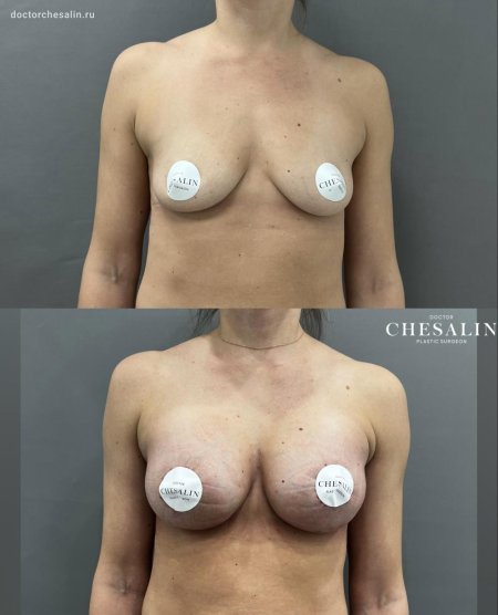 Увеличение груди имплантами