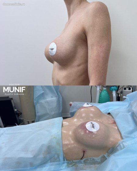 Пластика груди