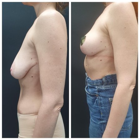 Якорная мастопексия без имплантов