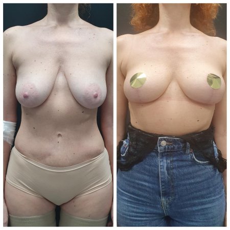 Якорная мастопексия без имплантов