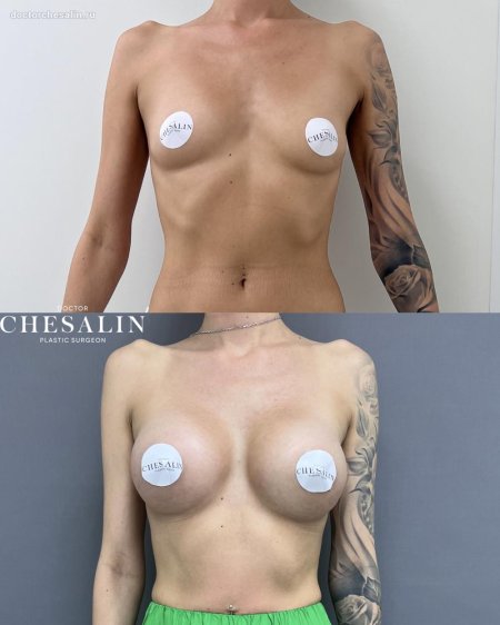 Увеличение груди имплантами