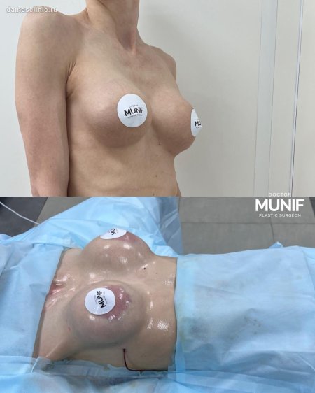 Увеличение груди