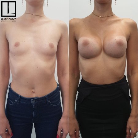 Пластика груди