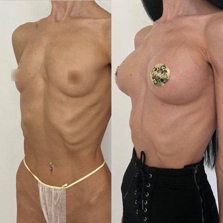 Увеличение груди имплантами