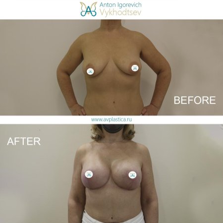 Пластика груди
