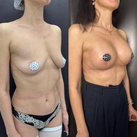 Увеличение груди имплантами