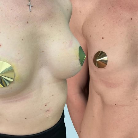 Треугольная тубулярная грудь