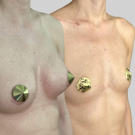 Увеличение груди имплантами