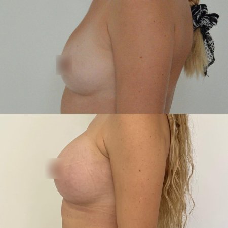 До и после увеличения груди