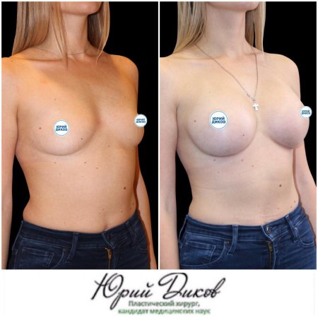 Сиськи круглый имплант