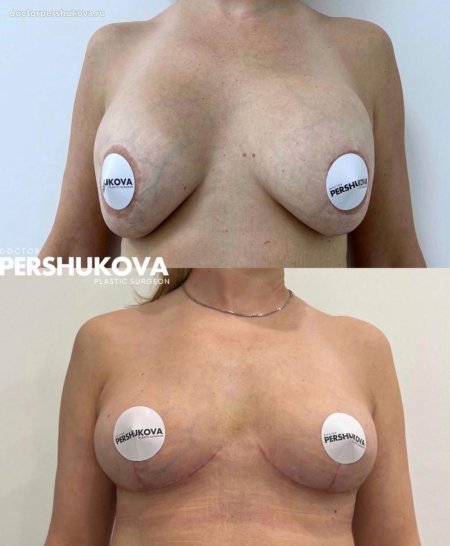 Якорная подтяжка молочных желез