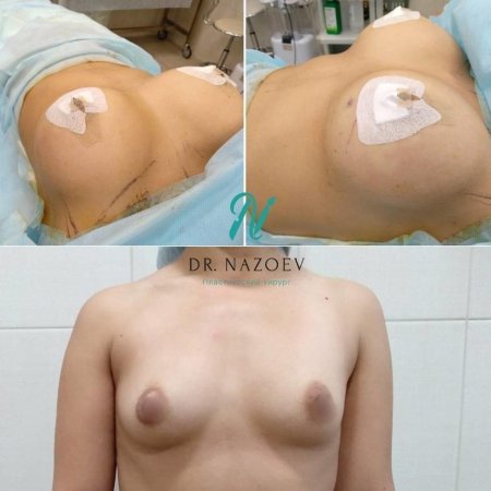 Анатомические импланты