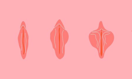 Интимная пластика лабиопластика