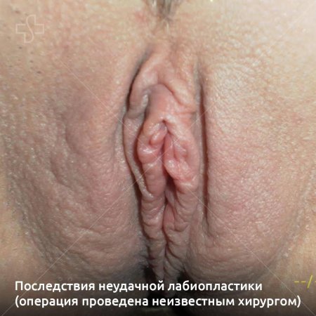 Неудачная пластика половых губ