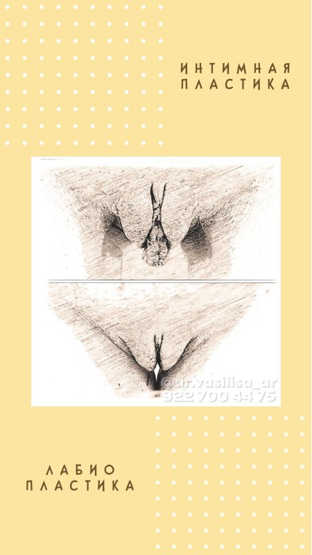 Пластика больших половых губ