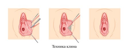 Эпизиотомия эпизиоррафия