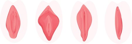 Вагина барби лабиопластика