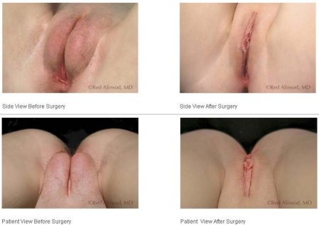 Пластика влагалища