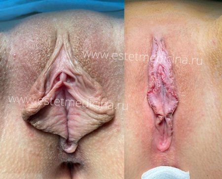 Редукционная лабиопластика