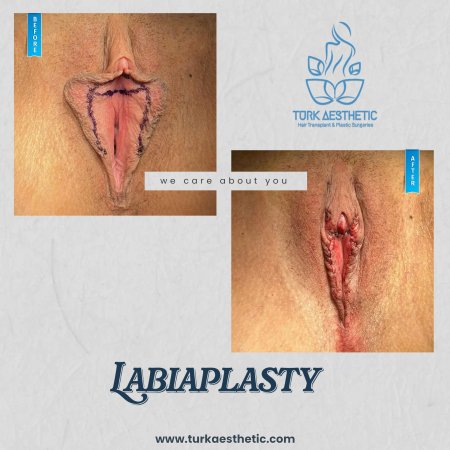 Женская интимная пластика