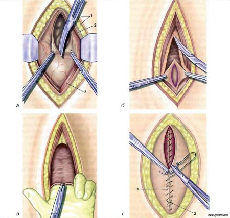 Нижнесрединная лапаротомия