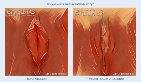 Пластика половых губ